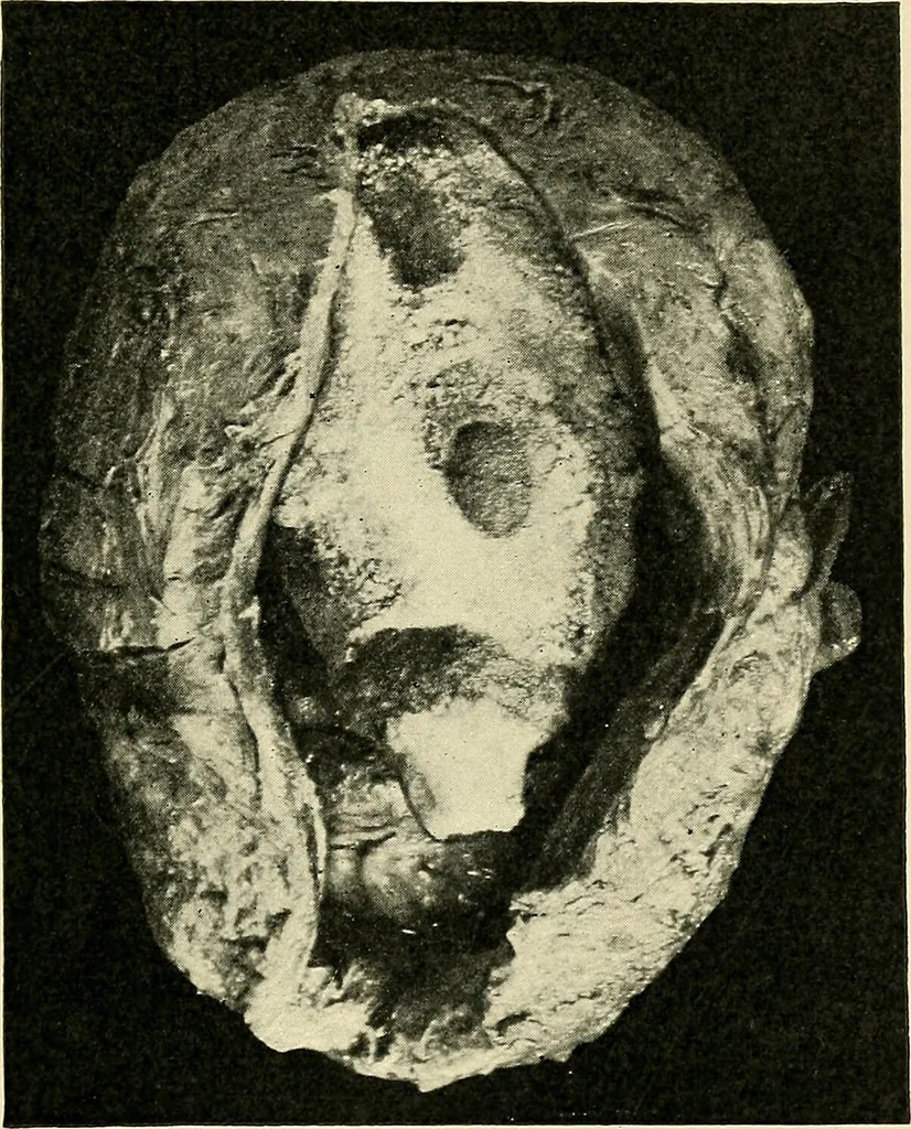 An illustration from A practical treatise on genito-urinary and venereal diseases and syphilis / By Robert W. Taylor., 1904, leaf 405