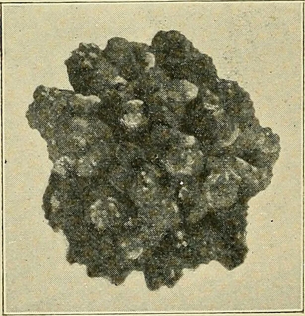 An illustration from A practical treatise on genito-urinary and venereal diseases and syphilis / By Robert W. Taylor., 1904, leaf 406