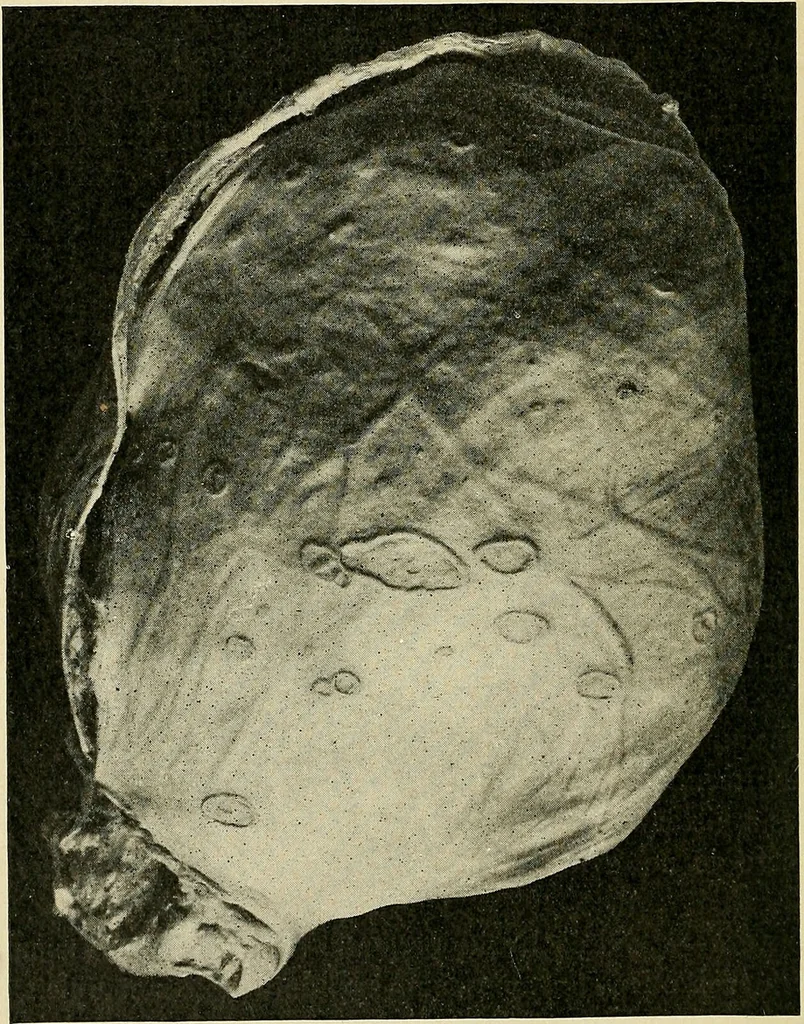 An illustration from A practical treatise on genito-urinary and venereal diseases and syphilis / By Robert W. Taylor., 1904, leaf 424