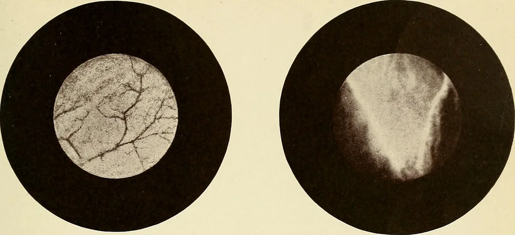 An illustration from A practical treatise on genito-urinary and venereal diseases and syphilis / By Robert W. Taylor., 1904, leaf 427