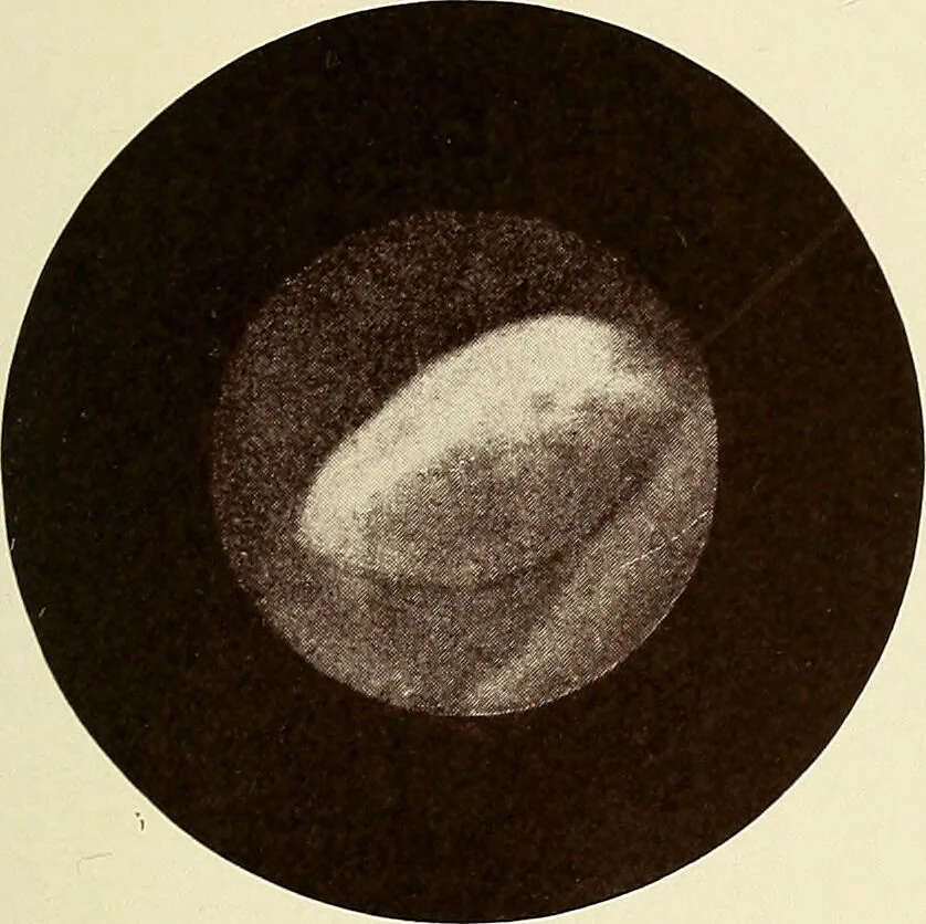 An illustration from A practical treatise on genito-urinary and venereal diseases and syphilis / By Robert W. Taylor., 1904, leaf 427