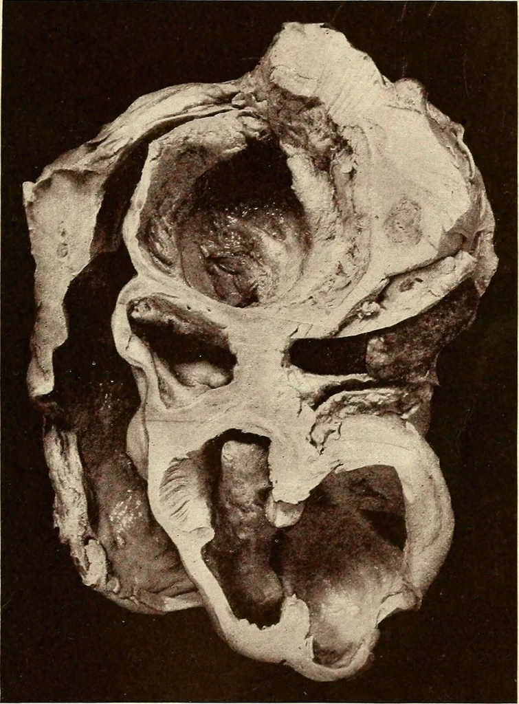 An illustration from A practical treatise on genito-urinary and venereal diseases and syphilis / By Robert W. Taylor., 1904, leaf 453