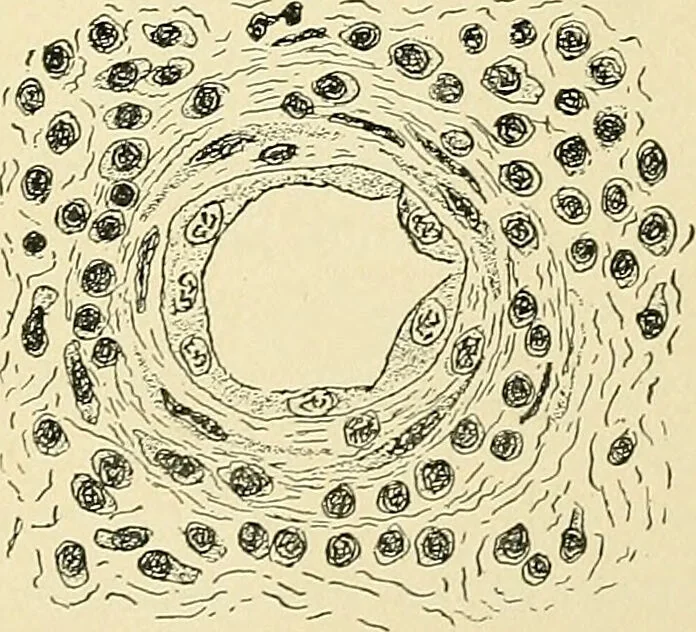 An illustration from A practical treatise on genito-urinary and venereal diseases and syphilis / By Robert W. Taylor., 1904, leaf 543