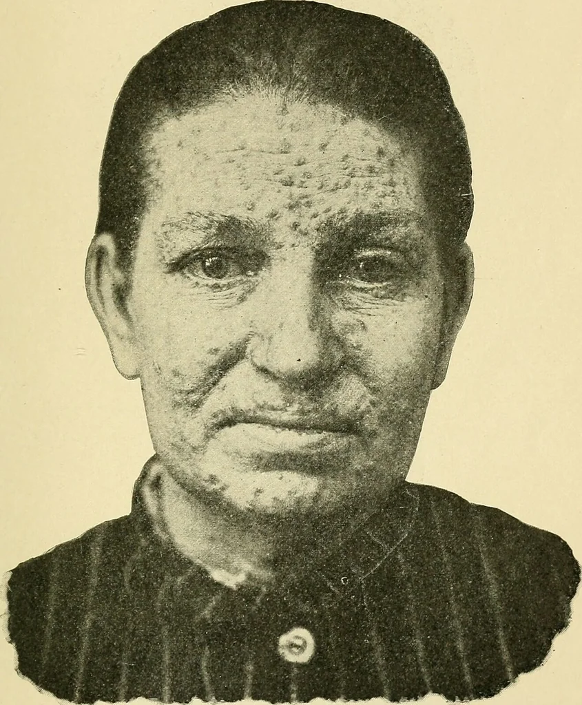 An illustration from A practical treatise on genito-urinary and venereal diseases and syphilis / By Robert W. Taylor., 1904, leaf 615