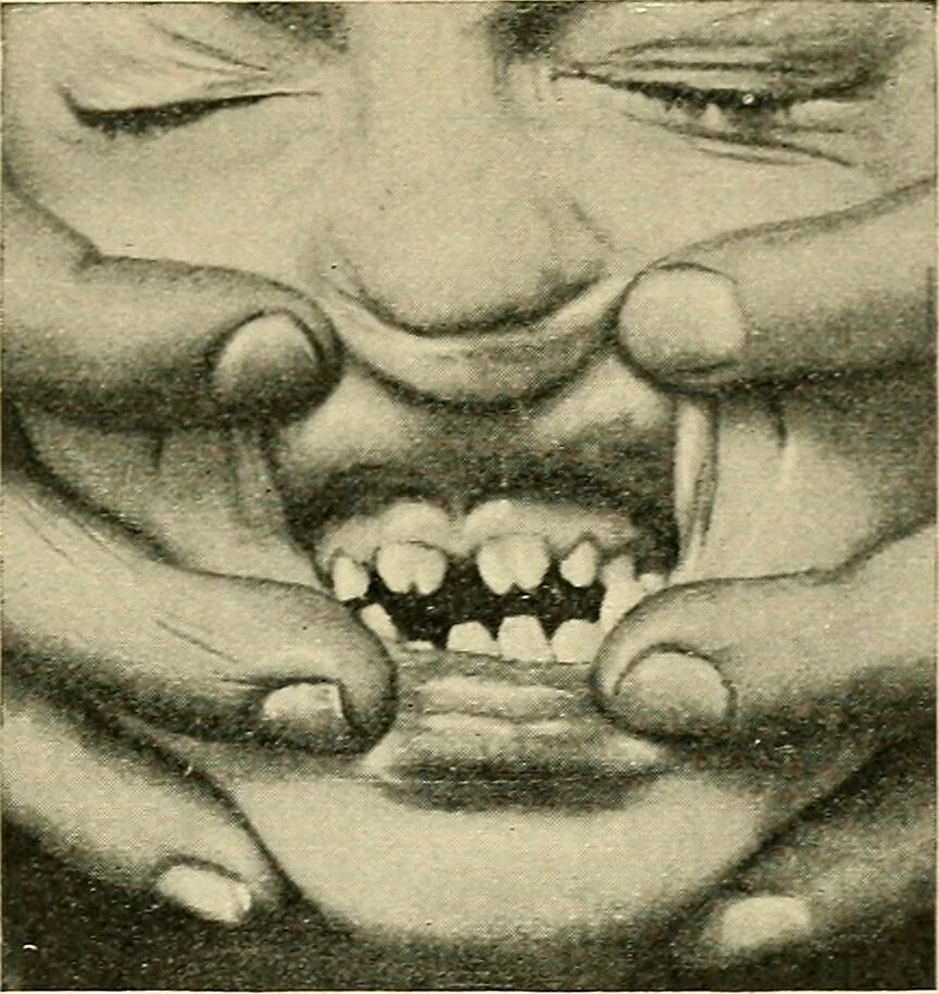 An illustration from A practical treatise on genito-urinary and venereal diseases and syphilis / By Robert W. Taylor., 1904, leaf 805