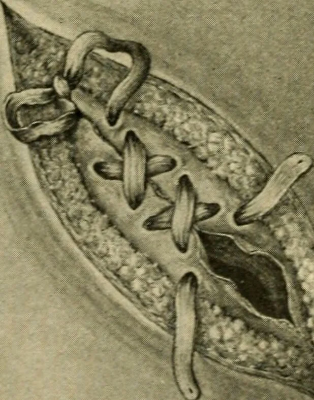 An illustration from The principles and practice of modern surgery / by Roswell Park ... with 722 engravings and 60 full-page plates in colors and monochrome., 1907, leaf 1014