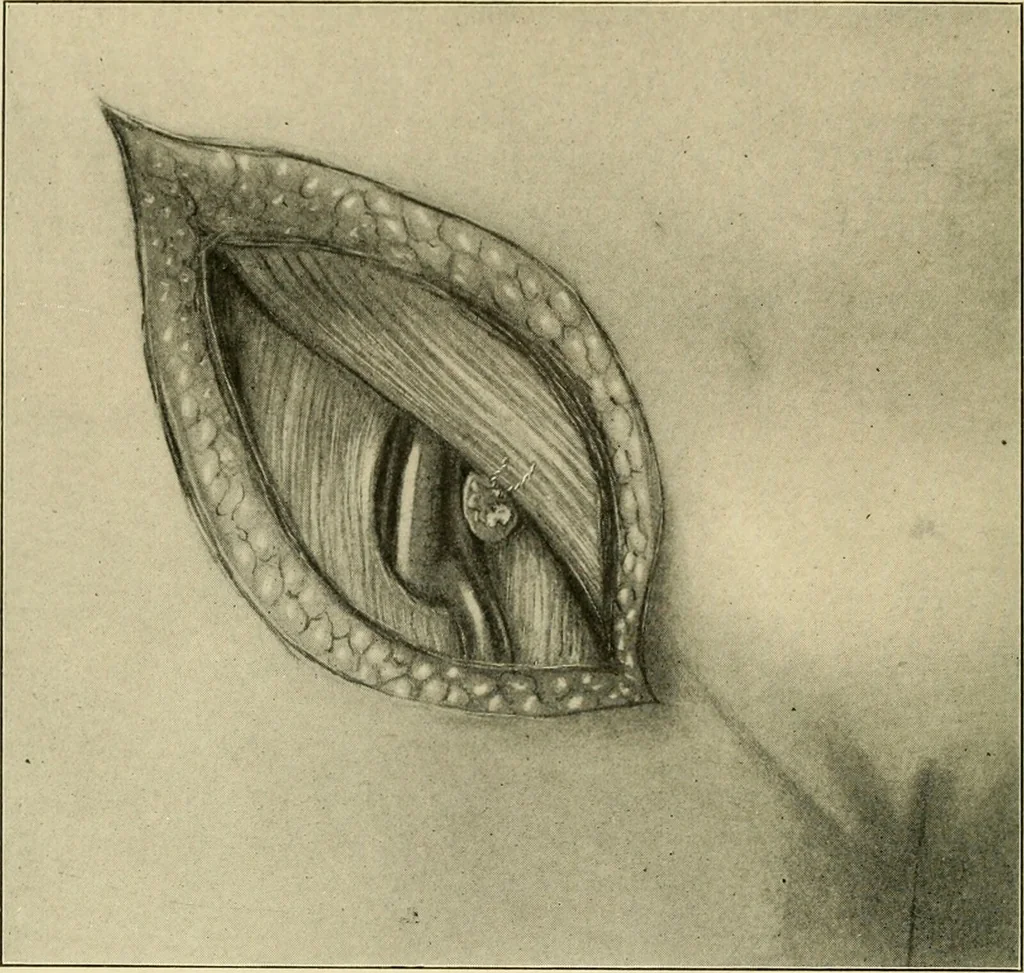 An illustration from The principles and practice of modern surgery / by Roswell Park ... with 722 engravings and 60 full-page plates in colors and monochrome., 1907, leaf 1016