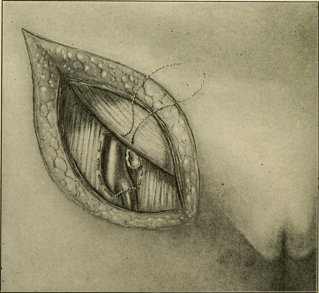 An illustration from The principles and practice of modern surgery / by Roswell Park ... with 722 engravings and 60 full-page plates in colors and monochrome., 1907, leaf 1016