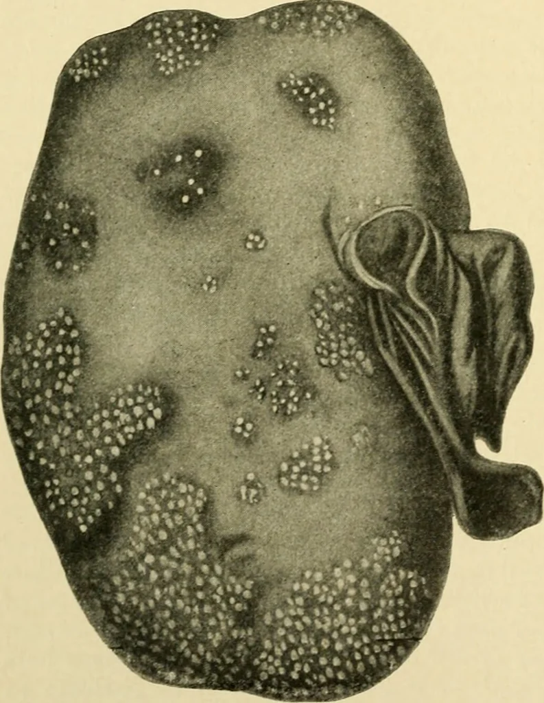 An illustration from The principles and practice of modern surgery / by Roswell Park ... with 722 engravings and 60 full-page plates in colors and monochrome., 1907, leaf 1074