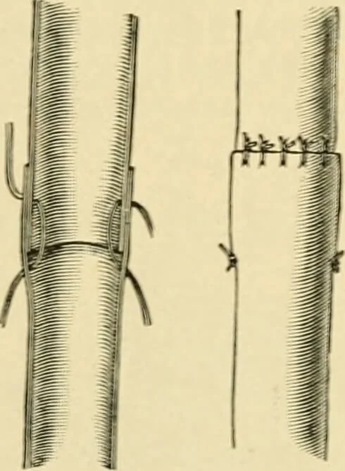 An illustration from The principles and practice of modern surgery / by Roswell Park ... with 722 engravings and 60 full-page plates in colors and monochrome., 1907, leaf 1090