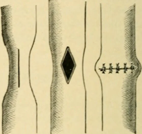 An illustration from The principles and practice of modern surgery / by Roswell Park ... with 722 engravings and 60 full-page plates in colors and monochrome., 1907, leaf 1090