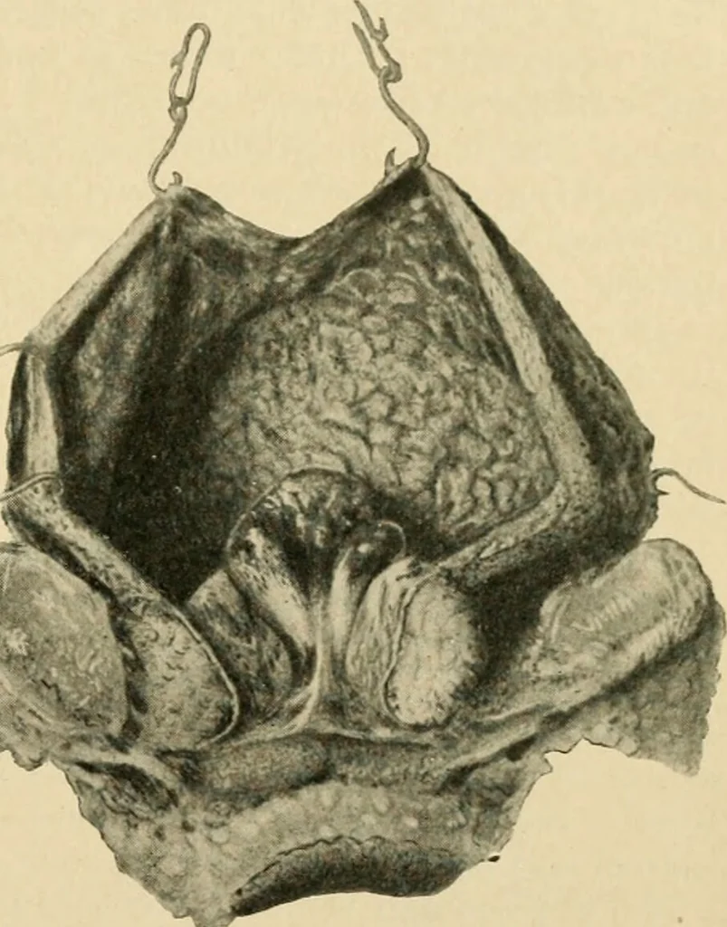 An illustration from The principles and practice of modern surgery / by Roswell Park ... with 722 engravings and 60 full-page plates in colors and monochrome., 1907, leaf 1111