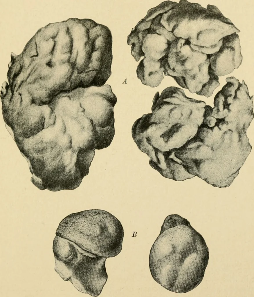 An illustration from The principles and practice of modern surgery / by Roswell Park ... with 722 engravings and 60 full-page plates in colors and monochrome., 1907, leaf 1115