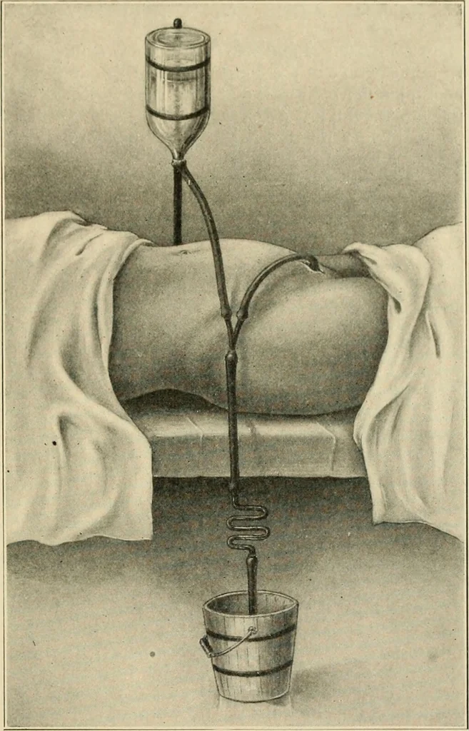 An illustration from The principles and practice of modern surgery / by Roswell Park ... with 722 engravings and 60 full-page plates in colors and monochrome., 1907, leaf 1117