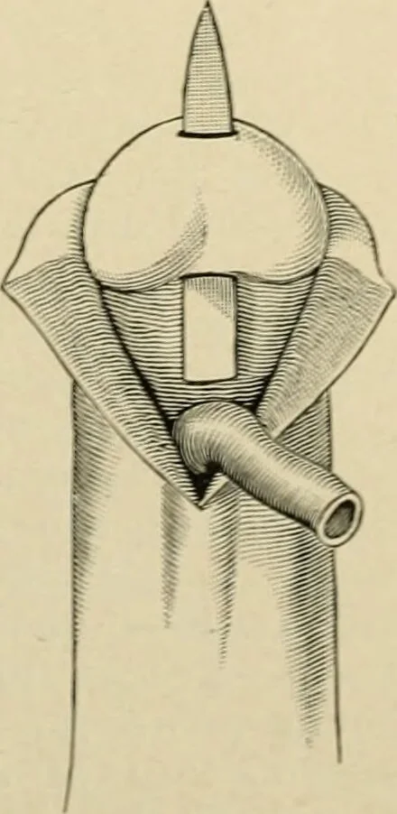 An illustration from The principles and practice of modern surgery / by Roswell Park ... with 722 engravings and 60 full-page plates in colors and monochrome., 1907, leaf 1120