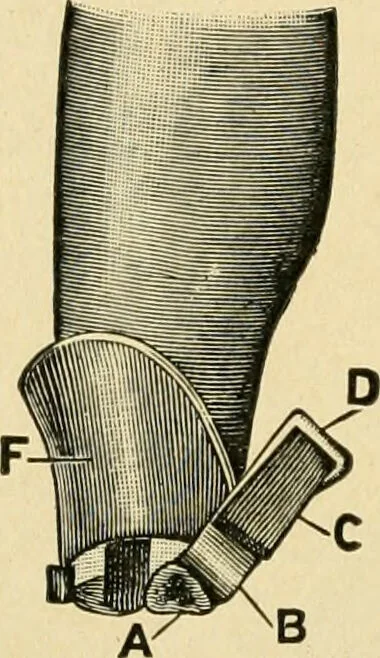 An illustration from The principles and practice of modern surgery / by Roswell Park ... with 722 engravings and 60 full-page plates in colors and monochrome., 1907, leaf 1142