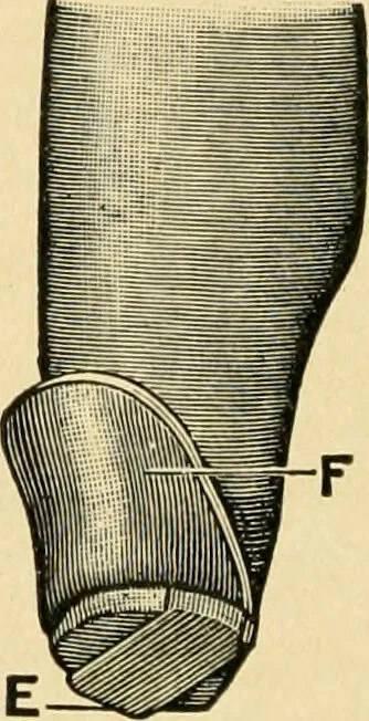 An illustration from The principles and practice of modern surgery / by Roswell Park ... with 722 engravings and 60 full-page plates in colors and monochrome., 1907, leaf 1142