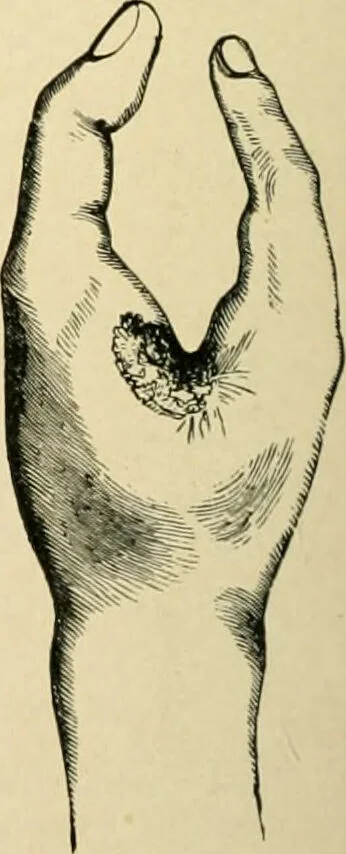 An illustration from The principles and practice of modern surgery / by Roswell Park ... with 722 engravings and 60 full-page plates in colors and monochrome., 1907, leaf 1144