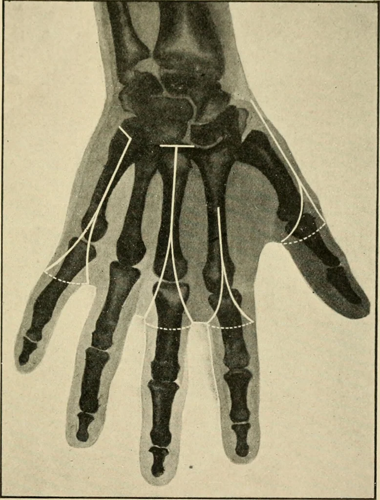 An illustration from The principles and practice of modern surgery / by Roswell Park ... with 722 engravings and 60 full-page plates in colors and monochrome., 1907, leaf 1145