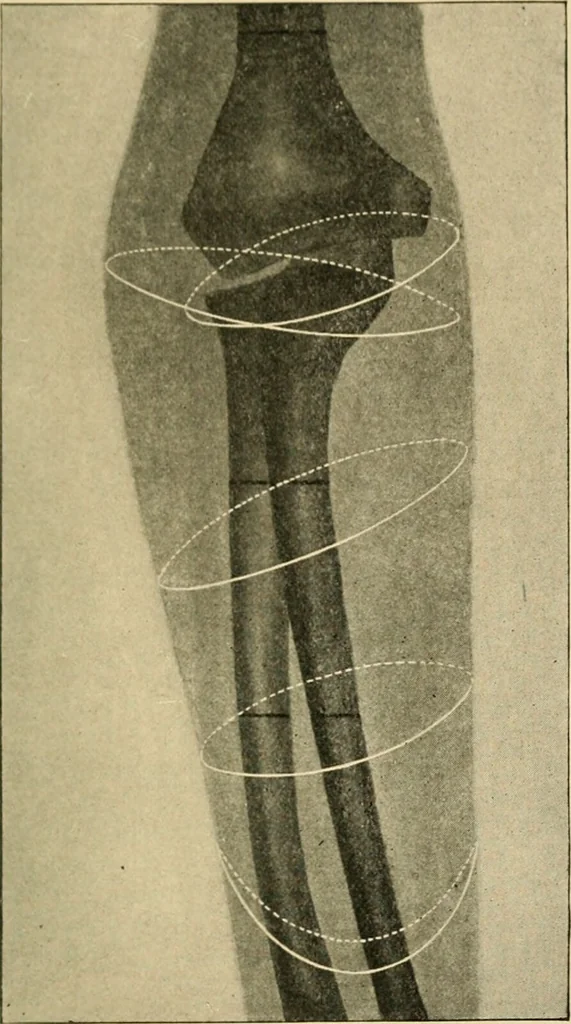 An illustration from The principles and practice of modern surgery / by Roswell Park ... with 722 engravings and 60 full-page plates in colors and monochrome., 1907, leaf 1151