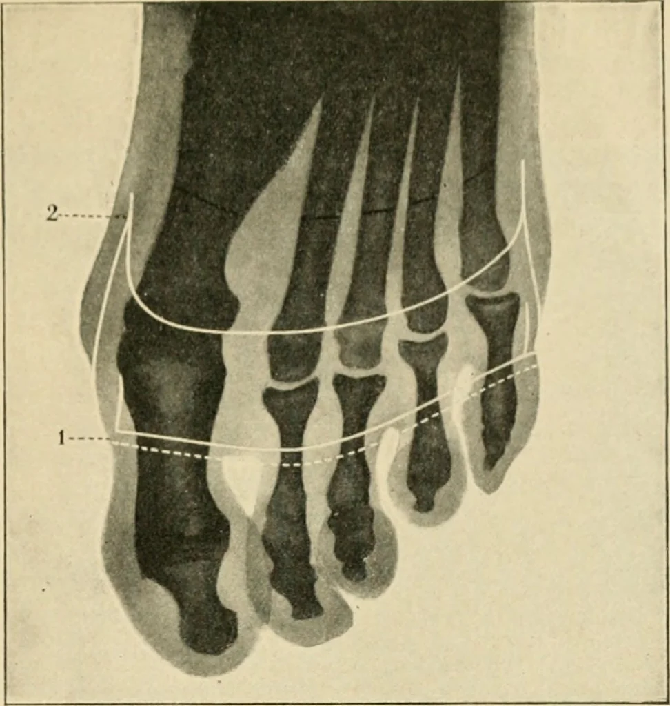 An illustration from The principles and practice of modern surgery / by Roswell Park ... with 722 engravings and 60 full-page plates in colors and monochrome., 1907, leaf 1153