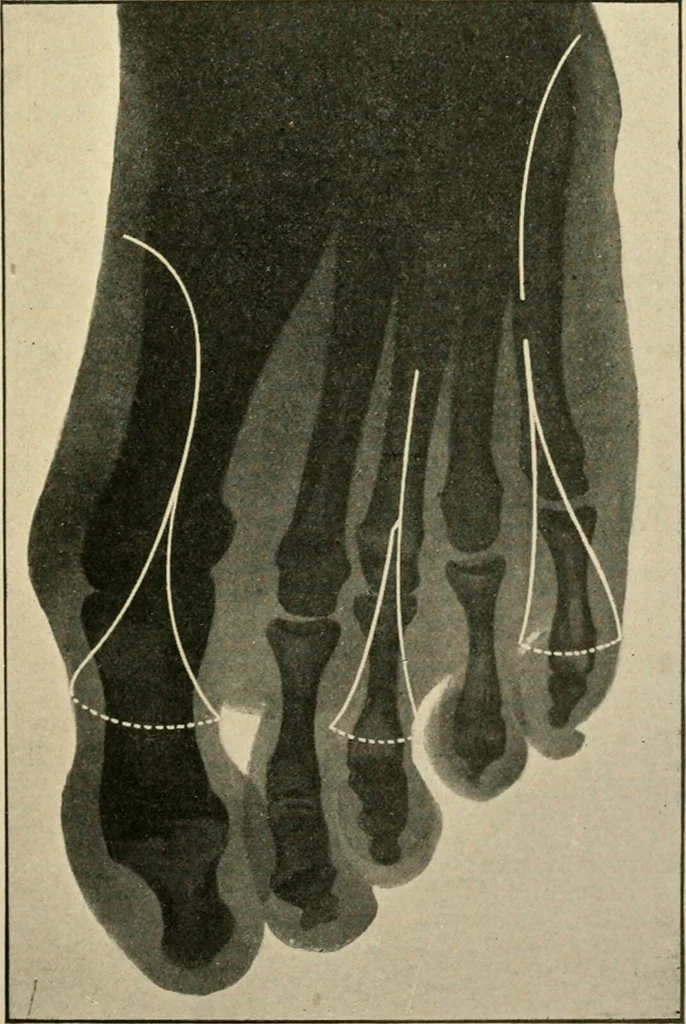 An illustration from The principles and practice of modern surgery / by Roswell Park ... with 722 engravings and 60 full-page plates in colors and monochrome., 1907, leaf 1153