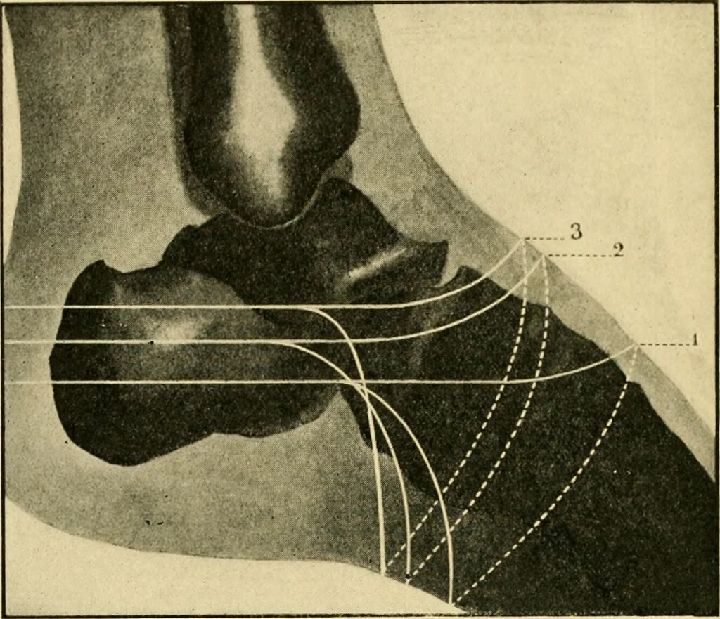 An illustration from The principles and practice of modern surgery / by Roswell Park ... with 722 engravings and 60 full-page plates in colors and monochrome., 1907, leaf 1154