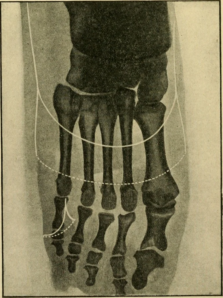 An illustration from The principles and practice of modern surgery / by Roswell Park ... with 722 engravings and 60 full-page plates in colors and monochrome., 1907, leaf 1154