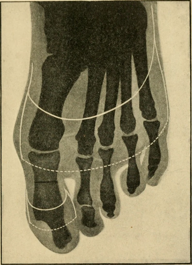 An illustration from The principles and practice of modern surgery / by Roswell Park ... with 722 engravings and 60 full-page plates in colors and monochrome., 1907, leaf 1155
