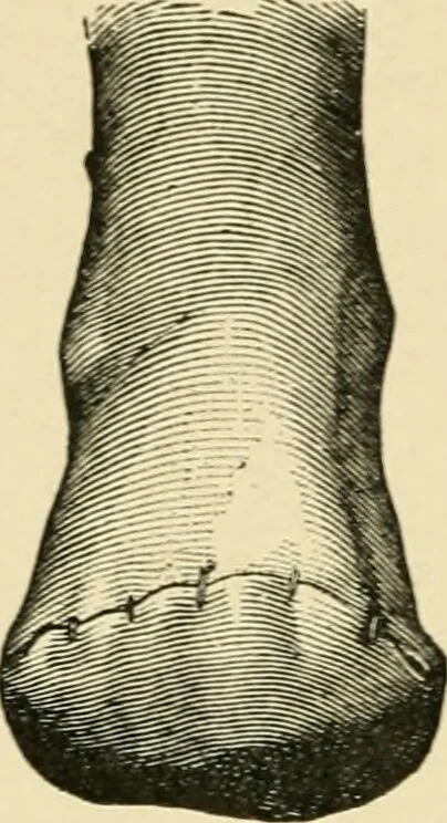 An illustration from The principles and practice of modern surgery / by Roswell Park ... with 722 engravings and 60 full-page plates in colors and monochrome., 1907, leaf 1156
