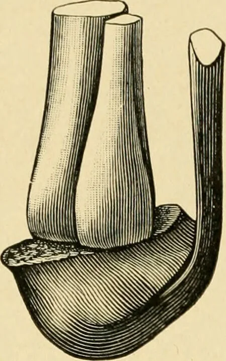 An illustration from The principles and practice of modern surgery / by Roswell Park ... with 722 engravings and 60 full-page plates in colors and monochrome., 1907, leaf 1158