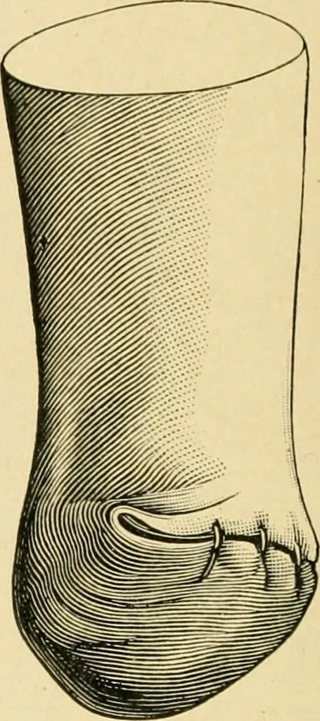 An illustration from The principles and practice of modern surgery / by Roswell Park ... with 722 engravings and 60 full-page plates in colors and monochrome., 1907, leaf 1158