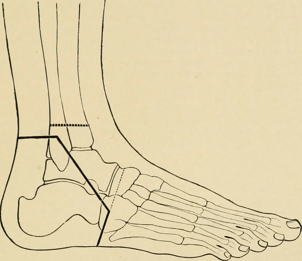An illustration from The principles and practice of modern surgery / by Roswell Park ... with 722 engravings and 60 full-page plates in colors and monochrome., 1907, leaf 1159
