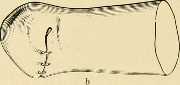 An illustration from The principles and practice of modern surgery / by Roswell Park ... with 722 engravings and 60 full-page plates in colors and monochrome., 1907, leaf 1162