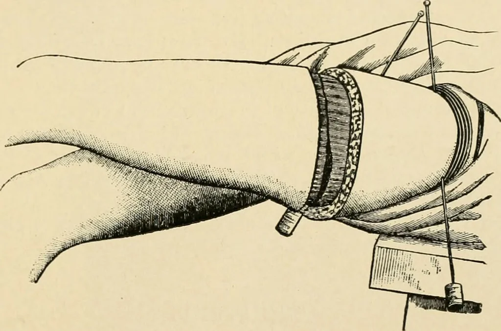 An illustration from The principles and practice of modern surgery / by Roswell Park ... with 722 engravings and 60 full-page plates in colors and monochrome., 1907, leaf 1163