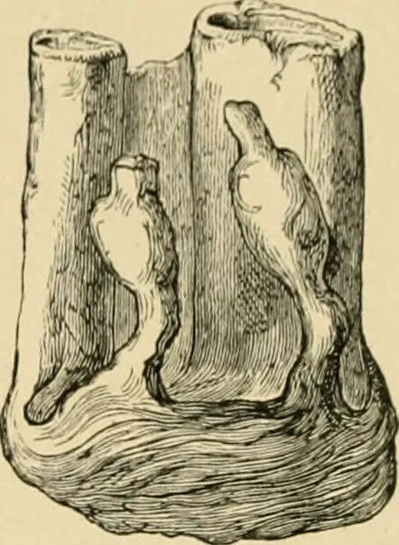An illustration from The principles and practice of modern surgery / by Roswell Park ... with 722 engravings and 60 full-page plates in colors and monochrome., 1907, leaf 1169