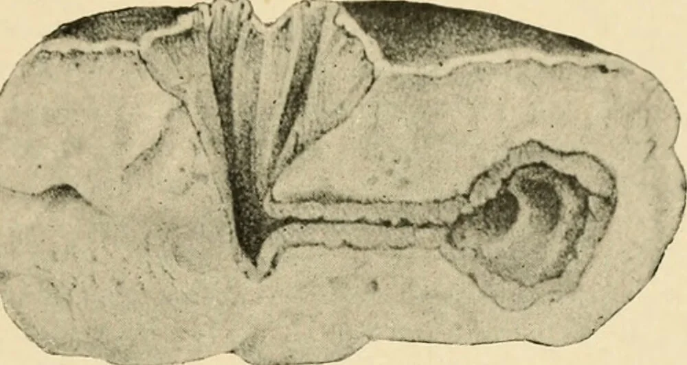 An illustration from The principles and practice of modern surgery / by Roswell Park ... with 722 engravings and 60 full-page plates in colors and monochrome., 1907, leaf 135