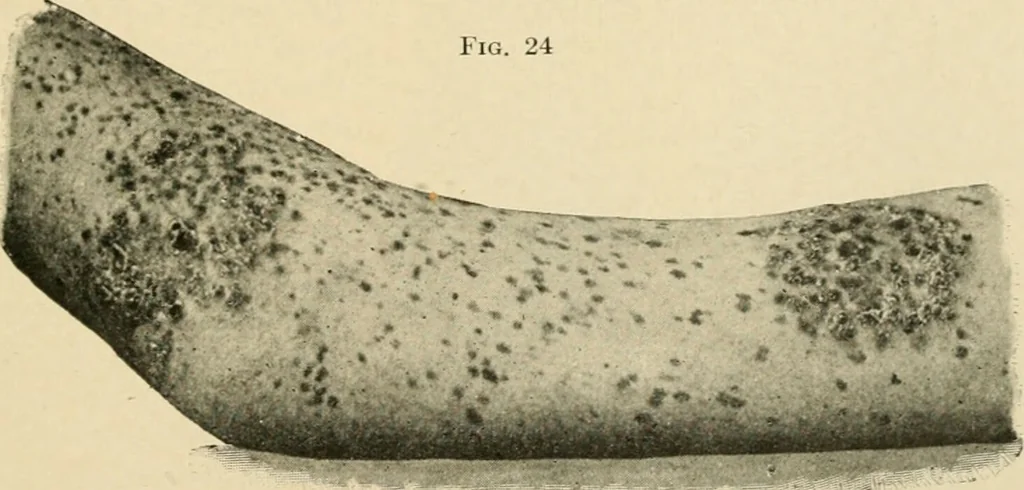 An illustration from The principles and practice of modern surgery / by Roswell Park ... with 722 engravings and 60 full-page plates in colors and monochrome., 1907, leaf 155