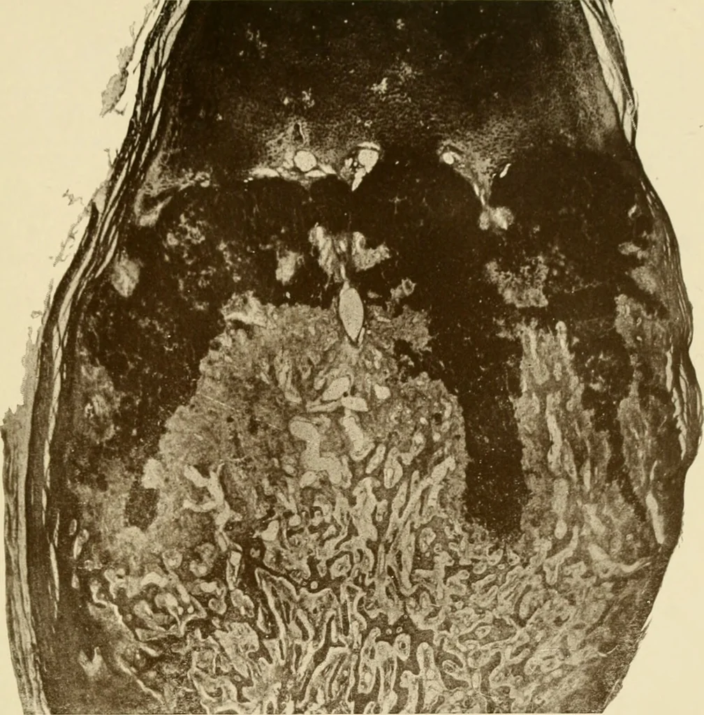 An illustration from The principles and practice of modern surgery / by Roswell Park ... with 722 engravings and 60 full-page plates in colors and monochrome., 1907, leaf 183
