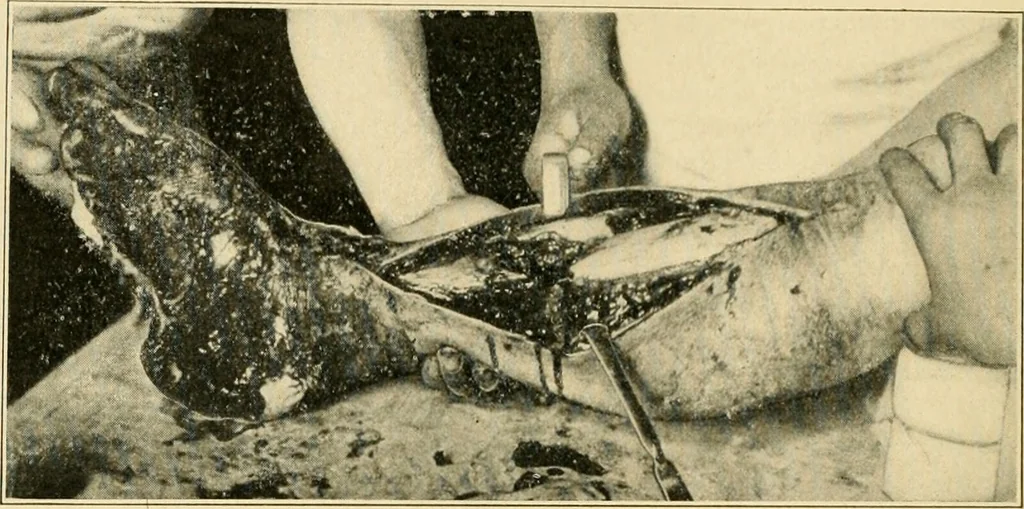 An illustration from The principles and practice of modern surgery / by Roswell Park ... with 722 engravings and 60 full-page plates in colors and monochrome., 1907, leaf 258
