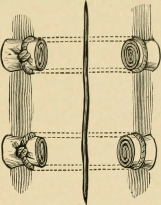 An illustration from The principles and practice of modern surgery / by Roswell Park ... with 722 engravings and 60 full-page plates in colors and monochrome., 1907, leaf 269