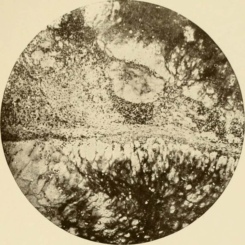 An illustration from The principles and practice of modern surgery / by Roswell Park ... with 722 engravings and 60 full-page plates in colors and monochrome., 1907, leaf 313