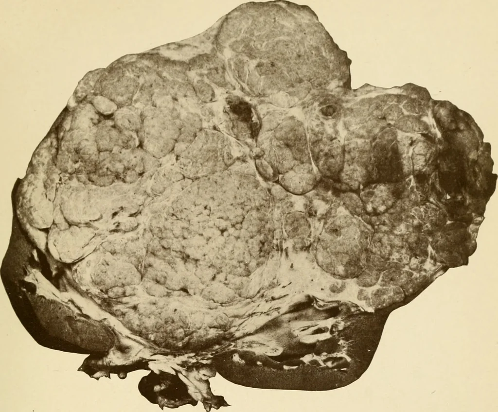 An illustration from The principles and practice of modern surgery / by Roswell Park ... with 722 engravings and 60 full-page plates in colors and monochrome., 1907, leaf 335