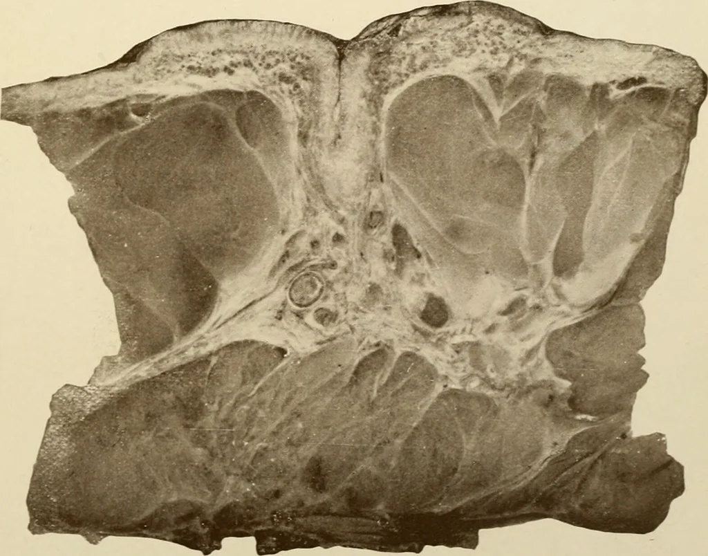 An illustration from The principles and practice of modern surgery / by Roswell Park ... with 722 engravings and 60 full-page plates in colors and monochrome., 1907, leaf 339