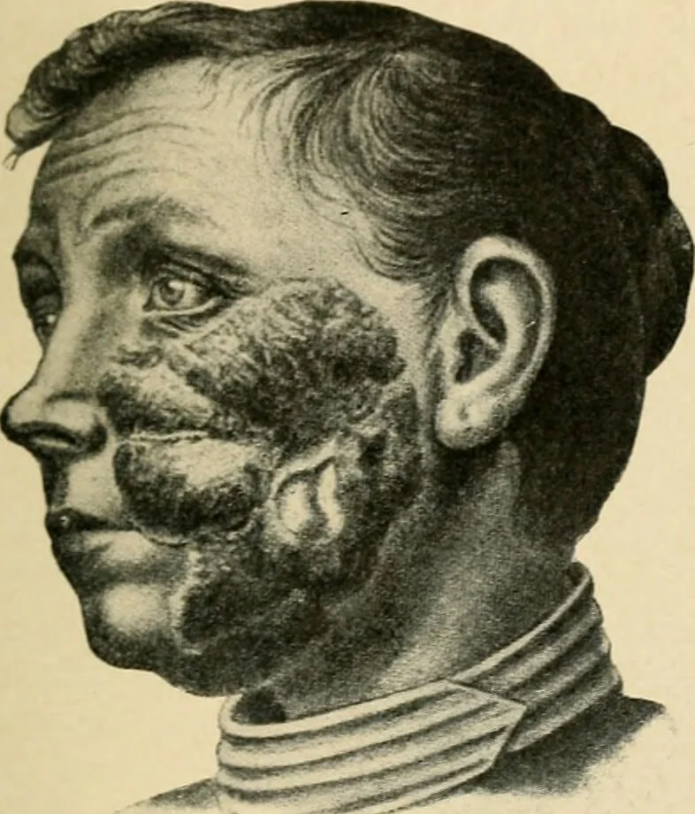 An illustration from The principles and practice of modern surgery / by Roswell Park ... with 722 engravings and 60 full-page plates in colors and monochrome., 1907, leaf 365
