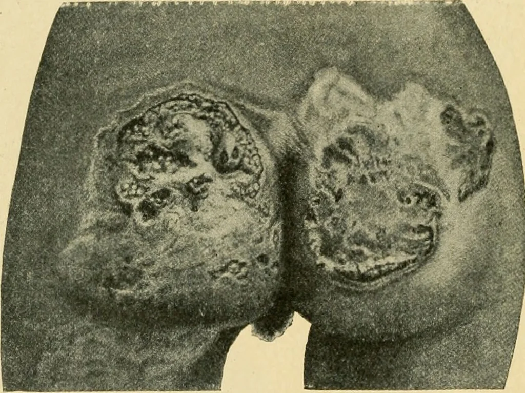 An illustration from The principles and practice of modern surgery / by Roswell Park ... with 722 engravings and 60 full-page plates in colors and monochrome., 1907, leaf 366
