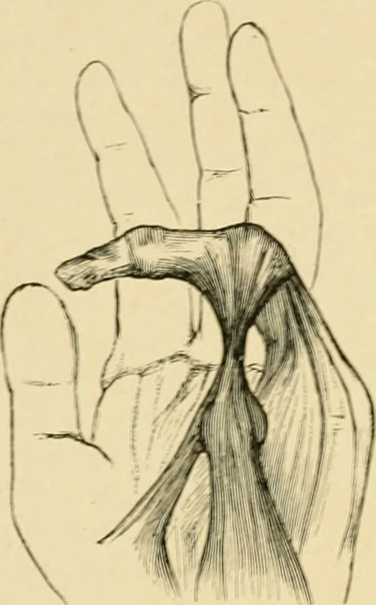 An illustration from The principles and practice of modern surgery / by Roswell Park ... with 722 engravings and 60 full-page plates in colors and monochrome., 1907, leaf 380
