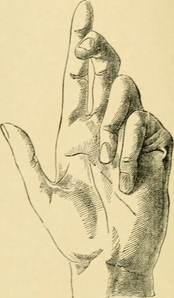 An illustration from The principles and practice of modern surgery / by Roswell Park ... with 722 engravings and 60 full-page plates in colors and monochrome., 1907, leaf 380