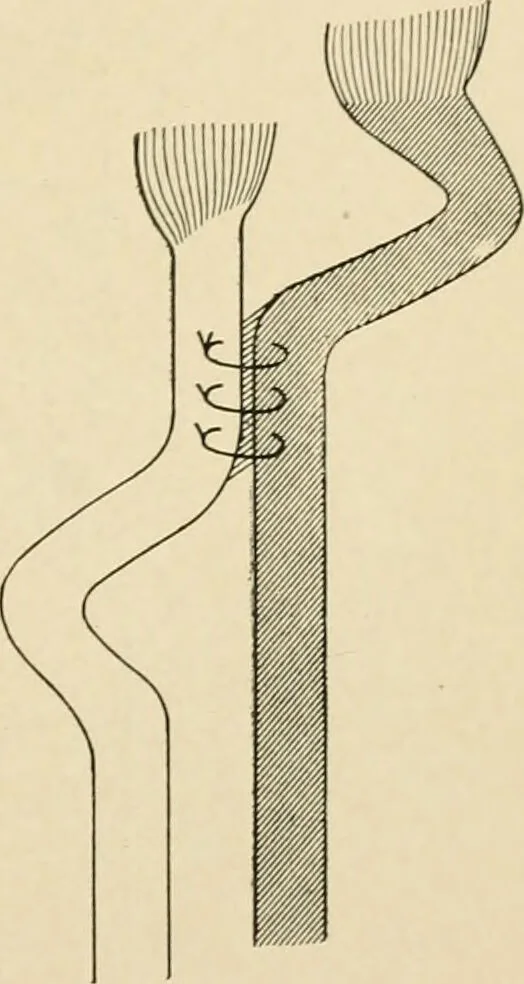An illustration from The principles and practice of modern surgery / by Roswell Park ... with 722 engravings and 60 full-page plates in colors and monochrome., 1907, leaf 383