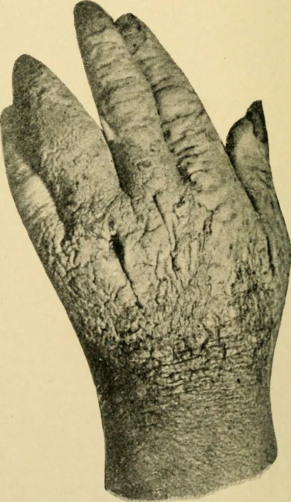 An illustration from The principles and practice of modern surgery / by Roswell Park ... with 722 engravings and 60 full-page plates in colors and monochrome., 1907, leaf 388